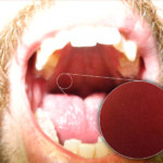 DSLR - Oral Cavity - Macro External Lighting - B