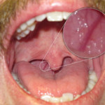 DSLR - Oral Cavity - Zoom External Lighting - A