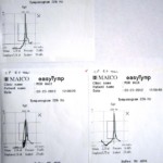Tympanometers - Printout - easyTymp - A