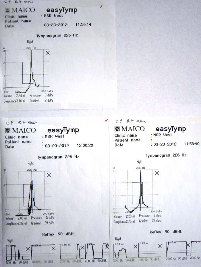 Tympanometers - Printout - easyTymp - A