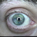 Patient Exam Cameras - AMD 2500 - Eye 01