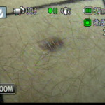 Patient Exam Cameras - Canon HF-M31 - Scar 01