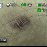 Patient Exam Cameras - Canon HF-M31 - Scar 02