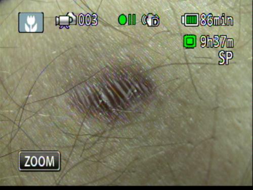 Patient Exam Cameras - Canon HF-M31 - Scar 02