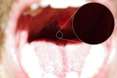 DSLR - Oral Cavity - Zoom External Lighting - B