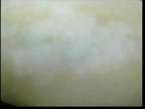Patient Exam Cameras - GE Home Monitor - Vitiligo